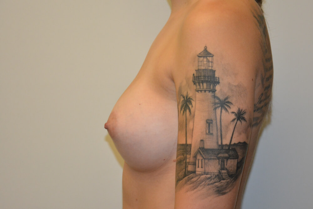Breast-Augmentation-19 | After Breast Augmentation 5