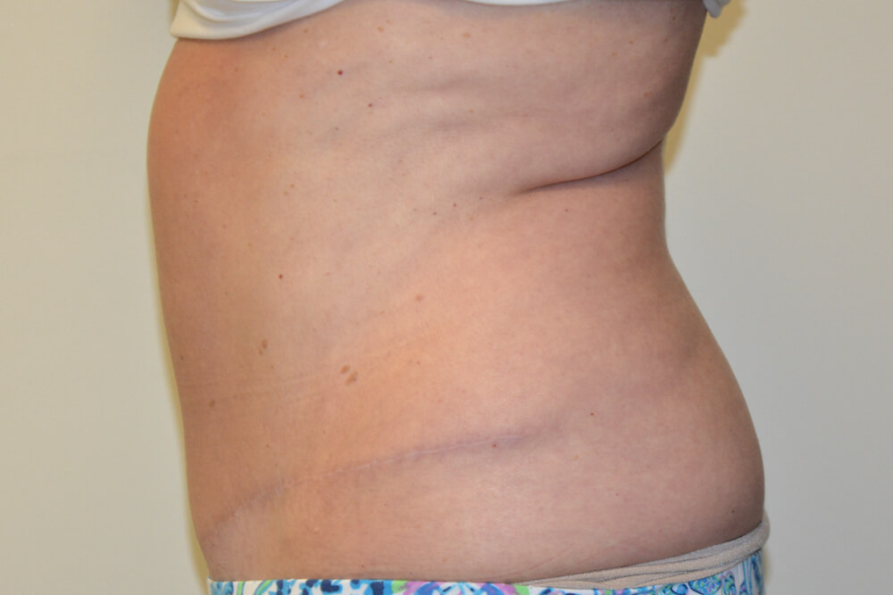 Tummy-Tuck-19 | After Tummy Tuck 5