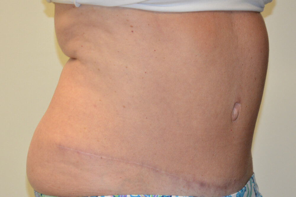 Tummy-Tuck-19 | After Tummy Tuck 2
