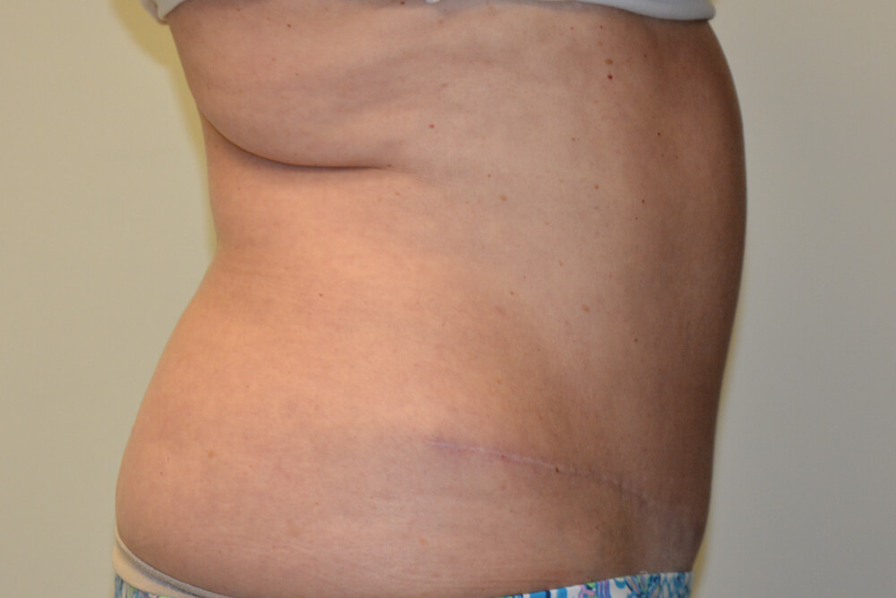 Tummy-Tuck-19 | After Tummy Tuck 3