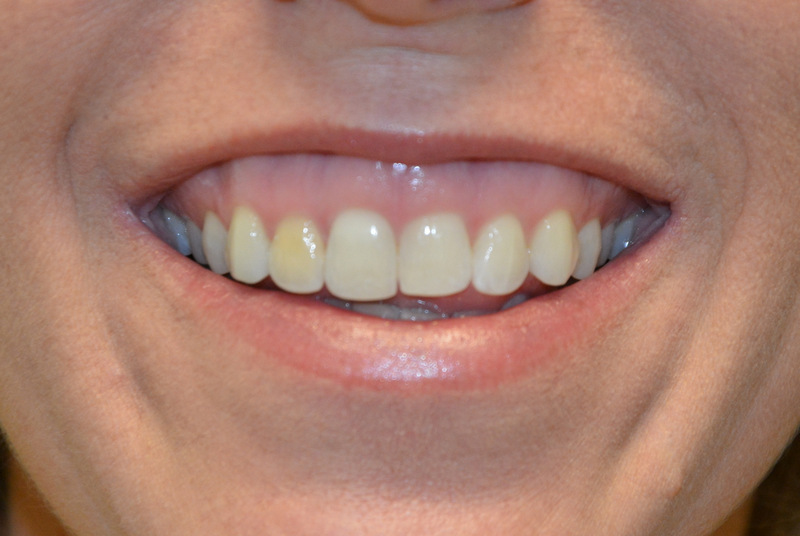 Botox---Cosmetic-03 | Before Botox® Cosmetic