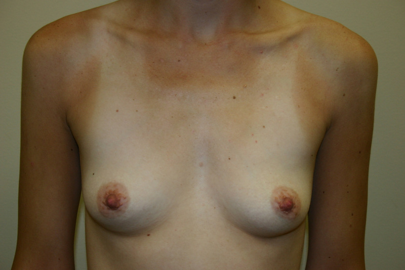 Breast-Augmentation-01 | Before Breast Augmentation