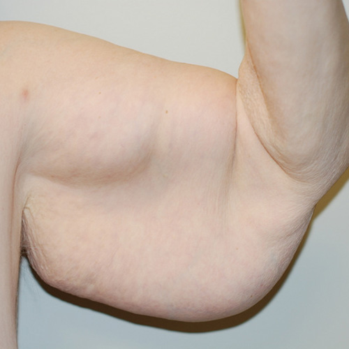 Arm-Lift-01 | Before Arm Lift 3