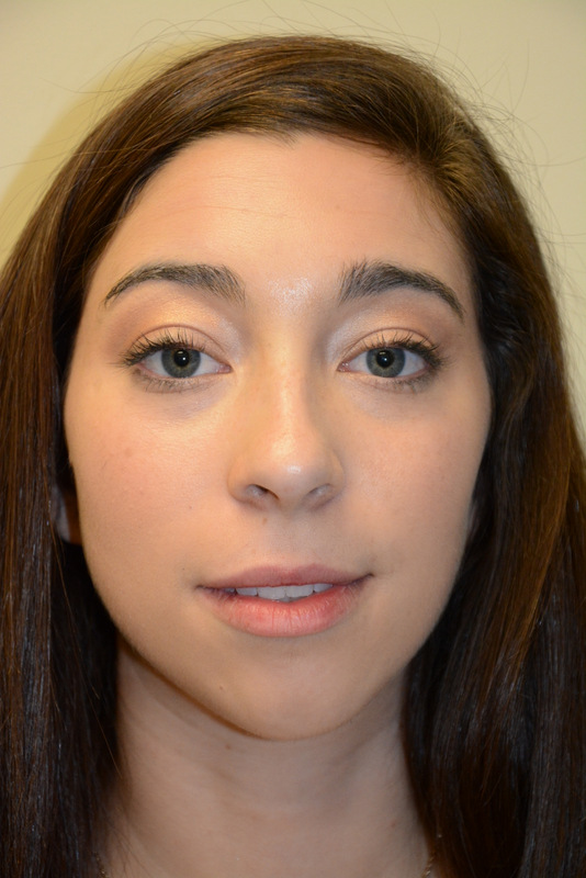 Chin-Augmentation-01 | Before Chin Augmentation