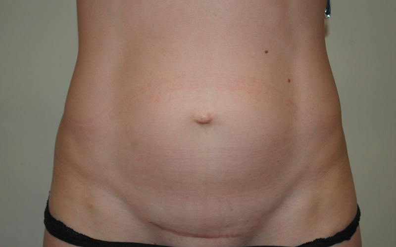 Mini-Tummy-Tuck-01 | Before Mini Tummy Tuck 1
