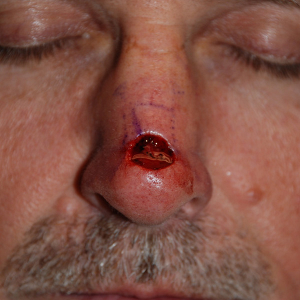 Skin-Cancer-Reconstruction-01 | Before Skin Cancer Reconstruction