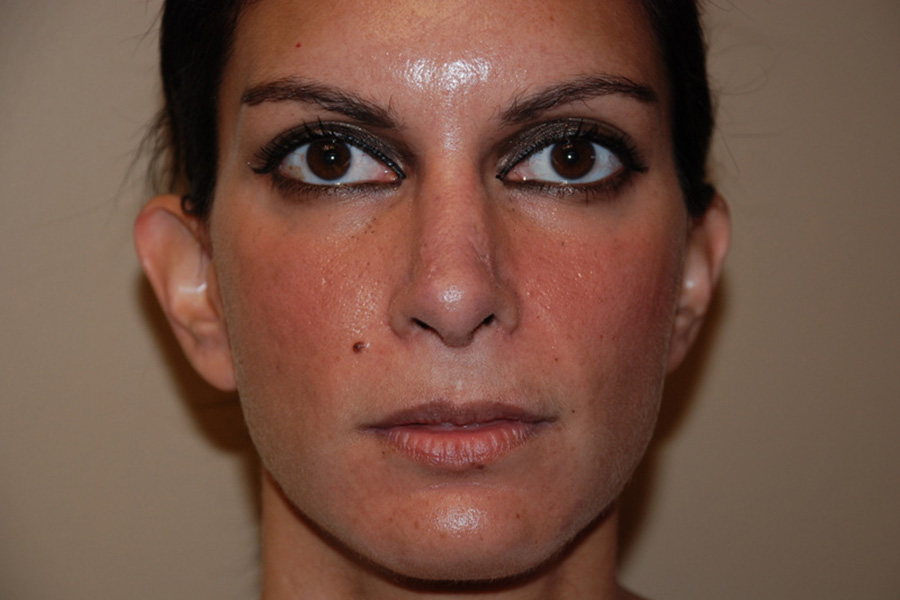 Prominent-Ear-Surgery-01 | Before Prominent Ear Surgery