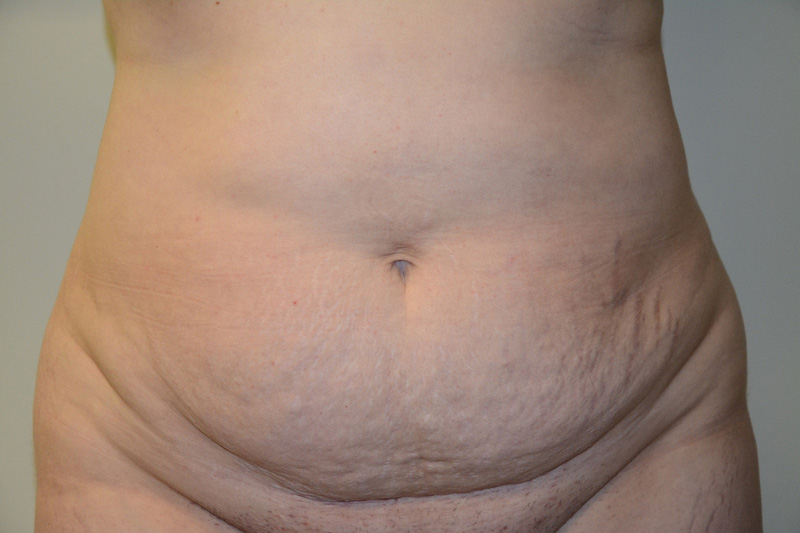 Tummy-Tuck-01 | Before Tummy Tuck
