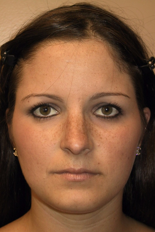 Rhinoplasty-01 | Before Rhinoplasty