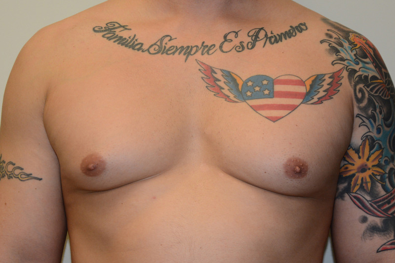 Male-Breast-Reduction-01 | Before Male Breast Reduction