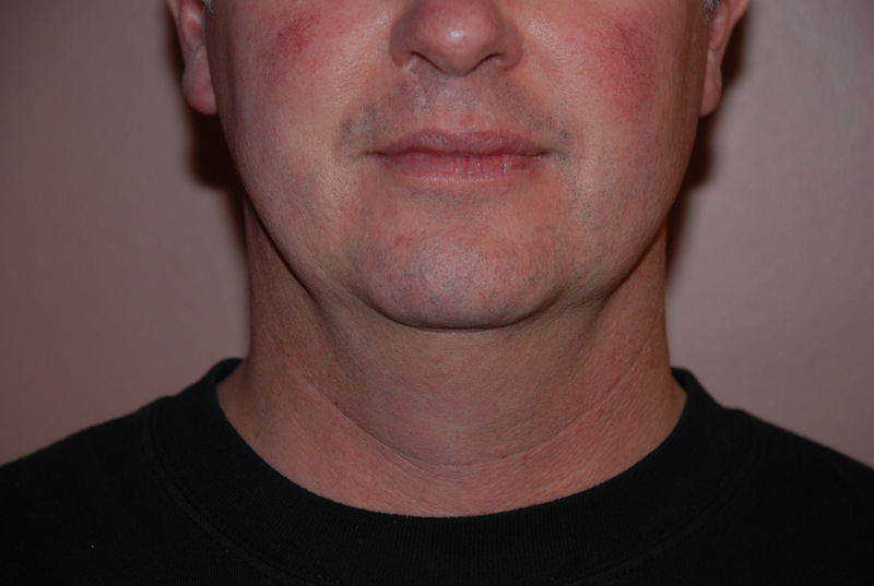 Neck-Liposuction-02 | Before Neck Liposuction