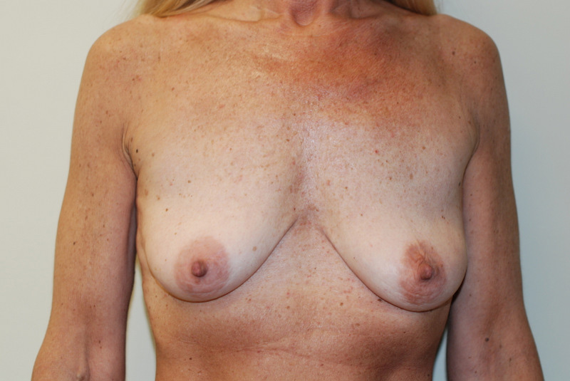 Breast-Lift-and-Augmentation-02 | Before Breast Lift and Augmentation