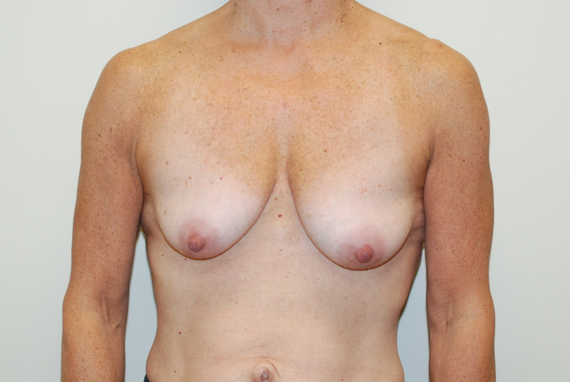 Breast-Reconstruction-Immediate-Implant-01 | Before Breast Reconstruction Immediate Implant
