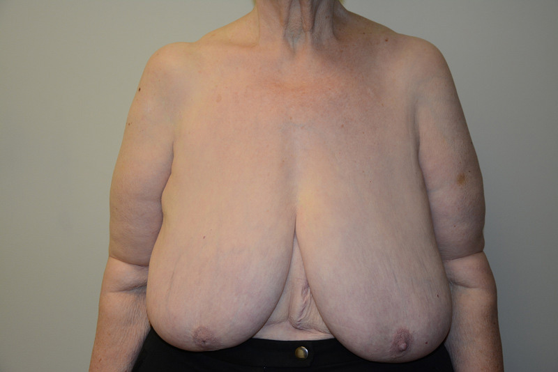 Breast-Reduction-01 | Before Breast Reduction