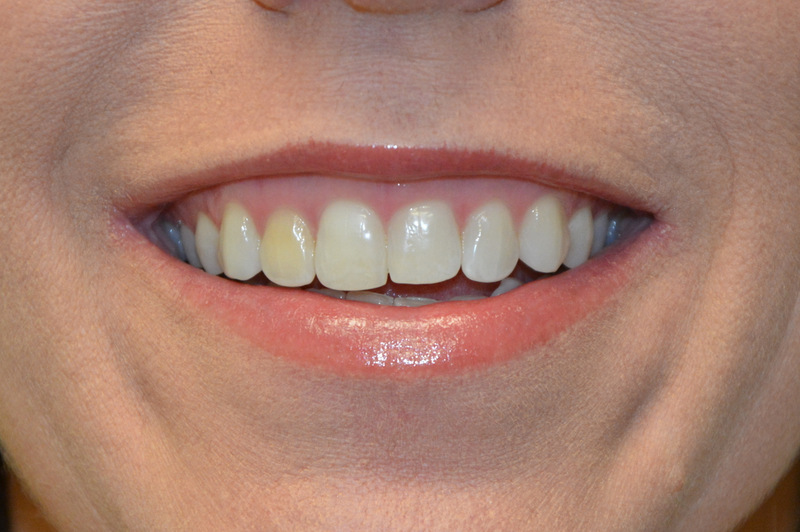 Botox---Cosmetic-03 | After Botox® Cosmetic