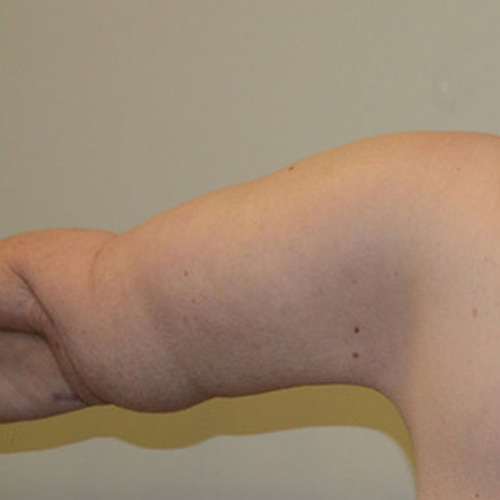 Arm-Lift-01 | After Arm Lift 2