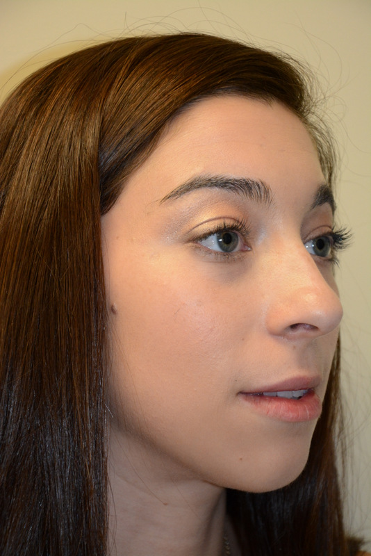 Chin-Augmentation-01 | Before Chin Augmentation 2