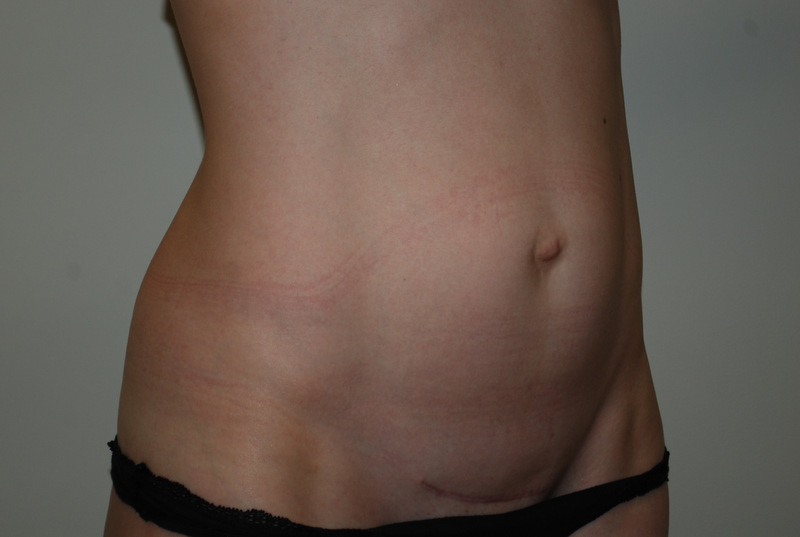 Mini-Tummy-Tuck-01 | Before Mini Tummy Tuck 2