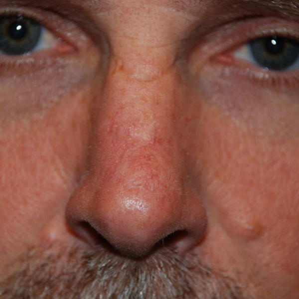 Skin-Cancer-Reconstruction-01 | After Skin Cancer Reconstruction