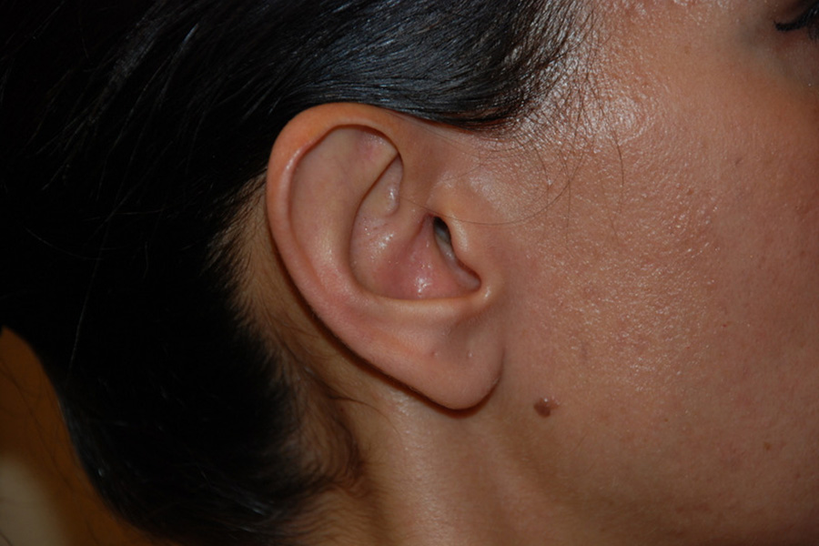 Prominent-Ear-Surgery-01 | Before Prominent Ear Surgery 2