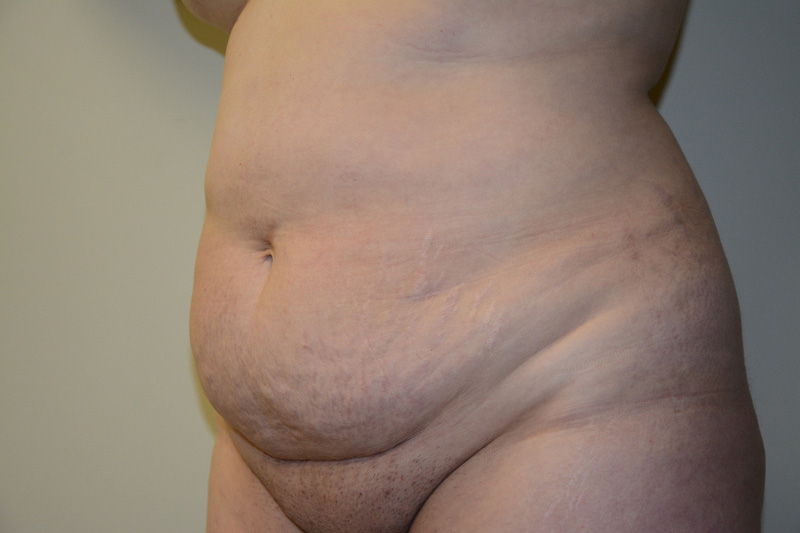 Tummy-Tuck-01 | Before Tummy Tuck 2