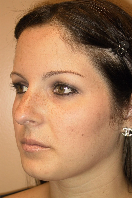 Rhinoplasty-01 | Before Rhinoplasty 2
