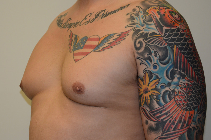 Male-Breast-Reduction-01 | Before Male Breast Reduction 2