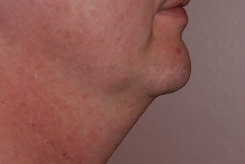 Neck-Liposuction-02 | Before Neck Liposuction 4