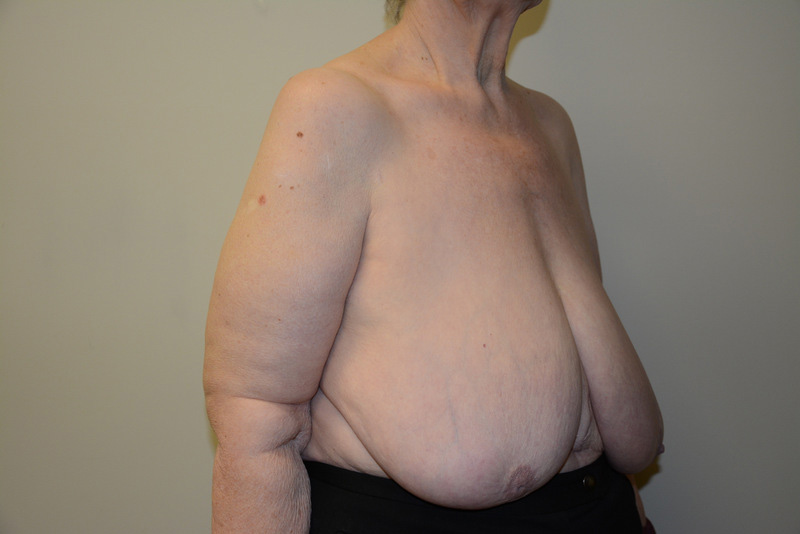 Breast-Reduction-01 | Before Breast Reduction 2