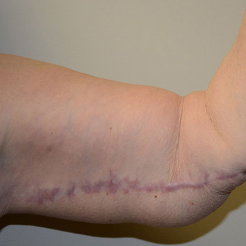 Arm-Lift-01 | After Arm Lift 3