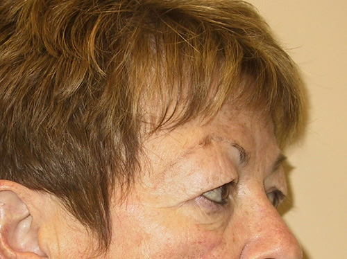 Eyelid-Surgery-02 | Before Eyelid Surgery 3