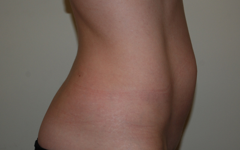 Mini-Tummy-Tuck-01 | Before Mini Tummy Tuck 3