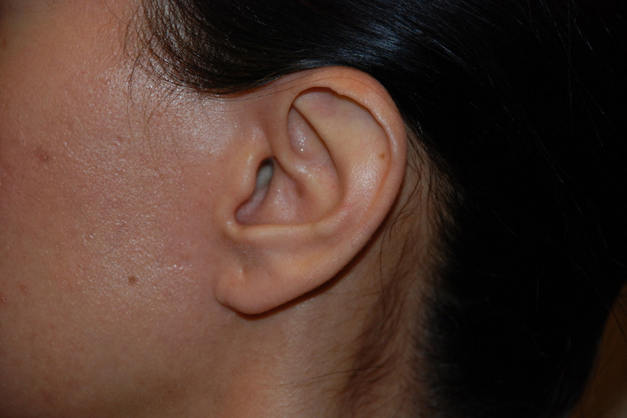 Prominent-Ear-Surgery-01 | Before Prominent Ear Surgery 3