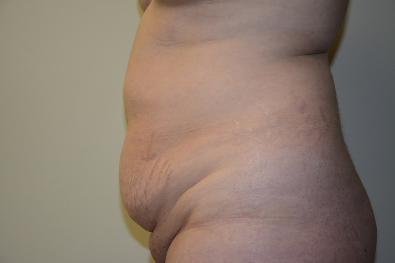 Tummy-Tuck-01 | Before Tummy Tuck 3