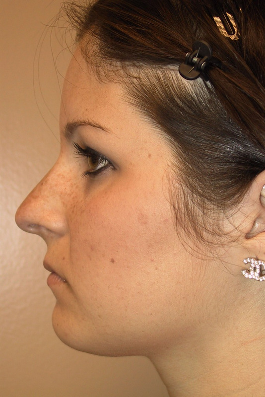 Rhinoplasty-01 | Before Rhinoplasty 3