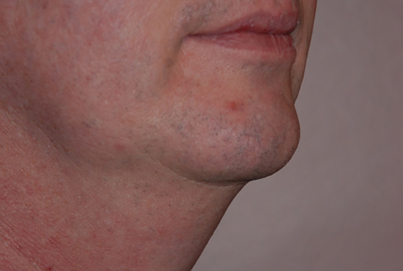 Neck-Liposuction-02 | Before Neck Liposuction 2