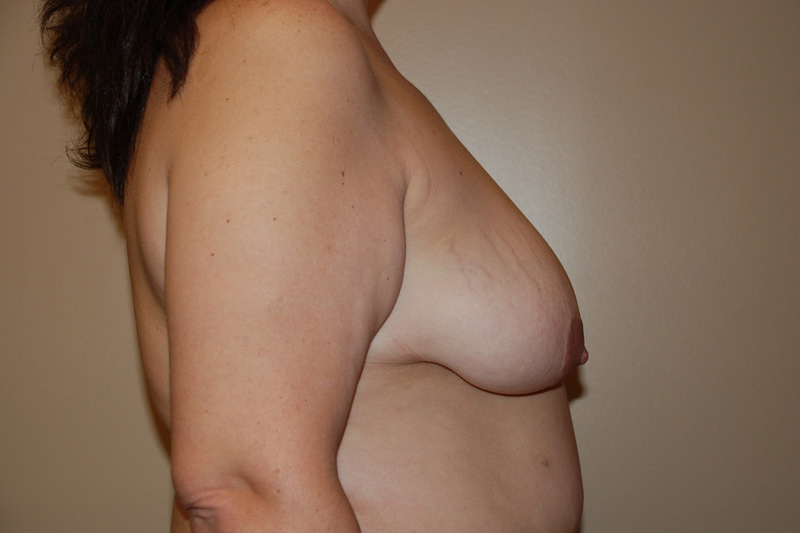 Breast-Lift-01 | Before Breast Lift 3