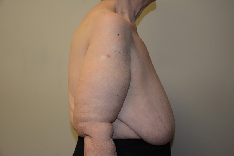 Breast-Reduction-01 | Before Breast Reduction 3