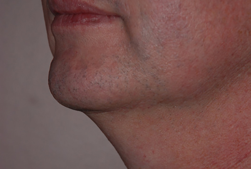 Neck-Liposuction-02 | Before Neck Liposuction 3