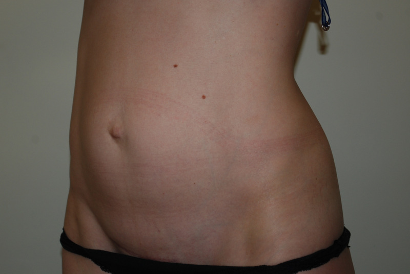 Mini-Tummy-Tuck-01 | Before Mini Tummy Tuck 4