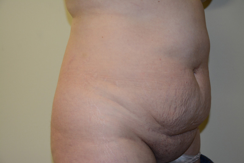 Tummy-Tuck-01 | Before Tummy Tuck 4
