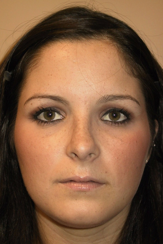 Rhinoplasty-01 | After Rhinoplasty