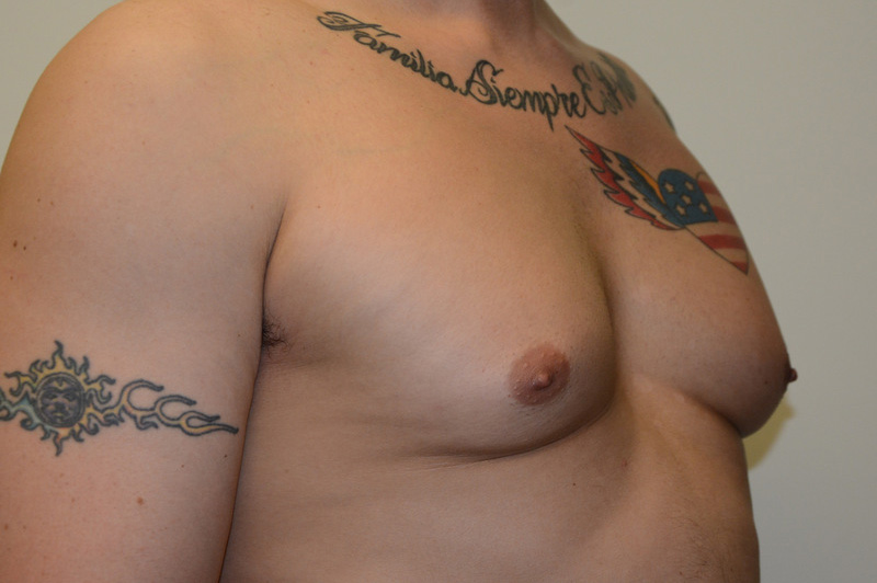 Male-Breast-Reduction-01 | Before Male Breast Reduction 4