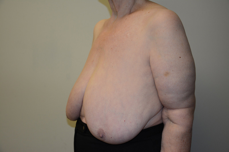 Breast-Reduction-01 | Before Breast Reduction 4