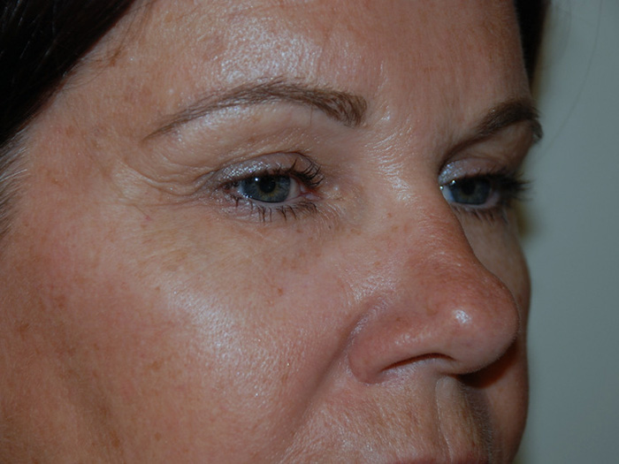 Brow-Lift-01 | Before Brow Lift 2