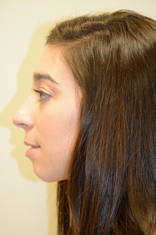 Chin-Augmentation-01 | Before Chin Augmentation 5