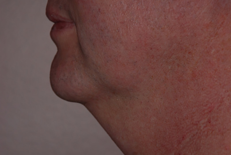 Neck-Liposuction-02 | Before Neck Liposuction 5
