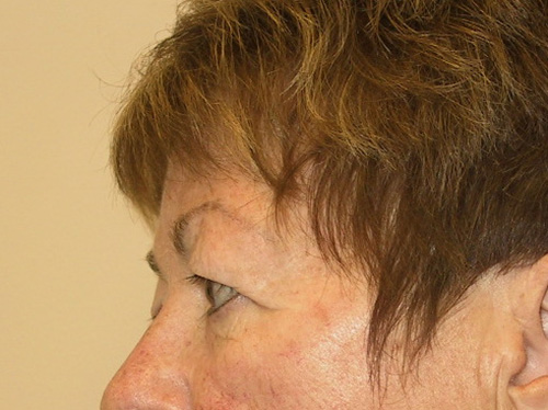 Eyelid-Surgery-02 | Before Eyelid Surgery 5