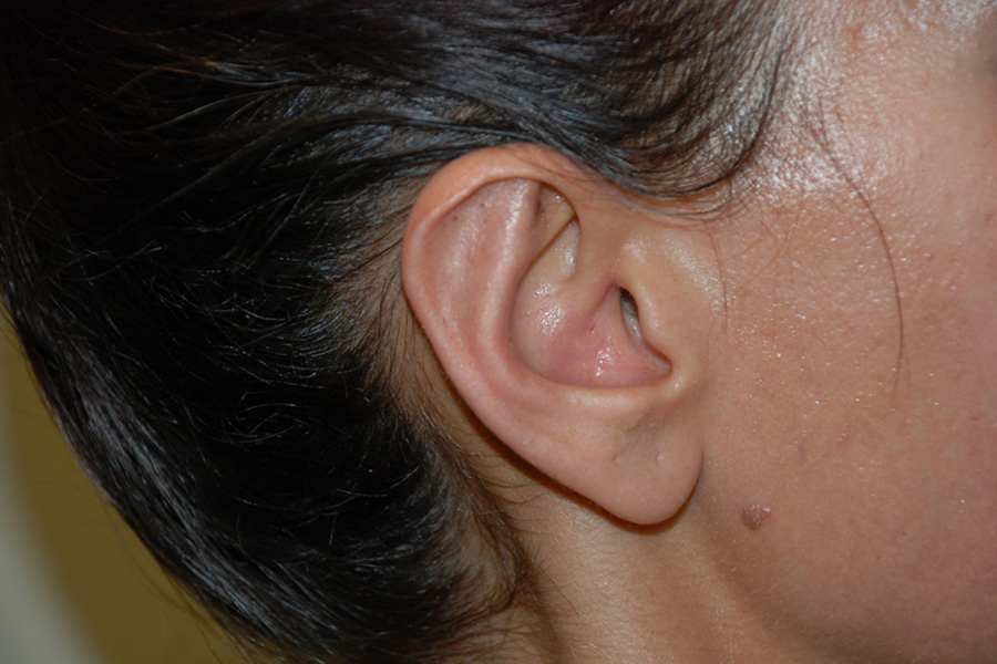 Prominent-Ear-Surgery-01 | After Prominent Ear Surgery 2