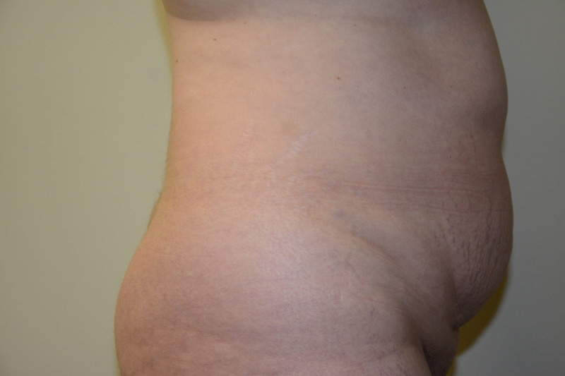 Tummy-Tuck-01 | Before Tummy Tuck 5